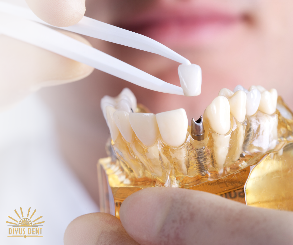 Gondolná, hogy a legkorábbi fogászati implantátum már több mint kétezer éves?
